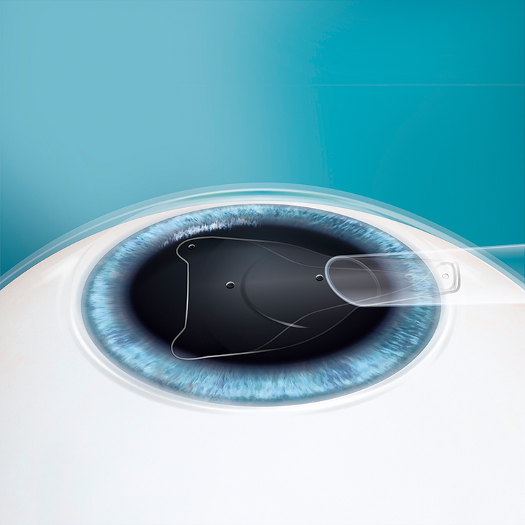 角膜切開・レンズ挿入